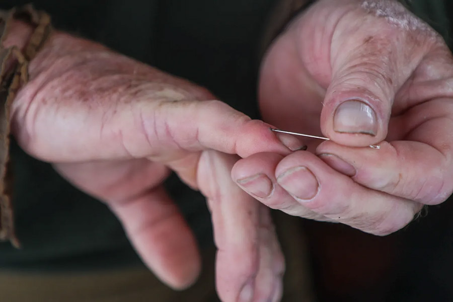 Matthew Pressly removes sea urchin spines from his fingers with a needle in San Diego